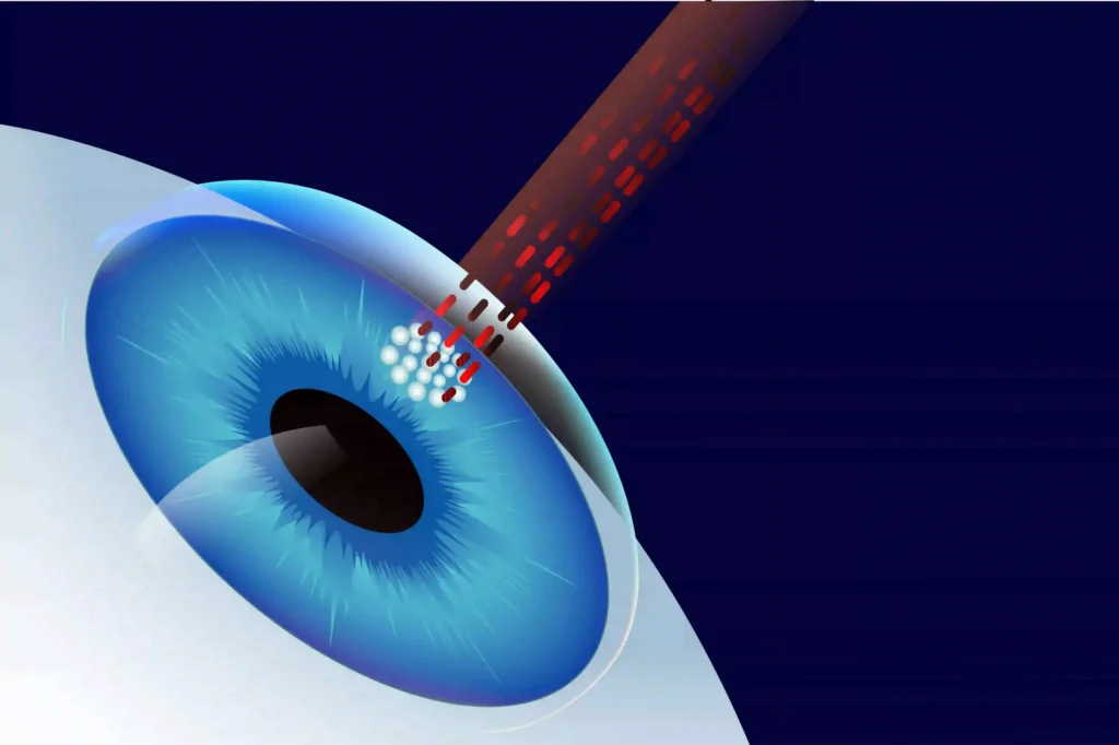How Does SMILE Eye Surgery Differ From Traditional LASIK?