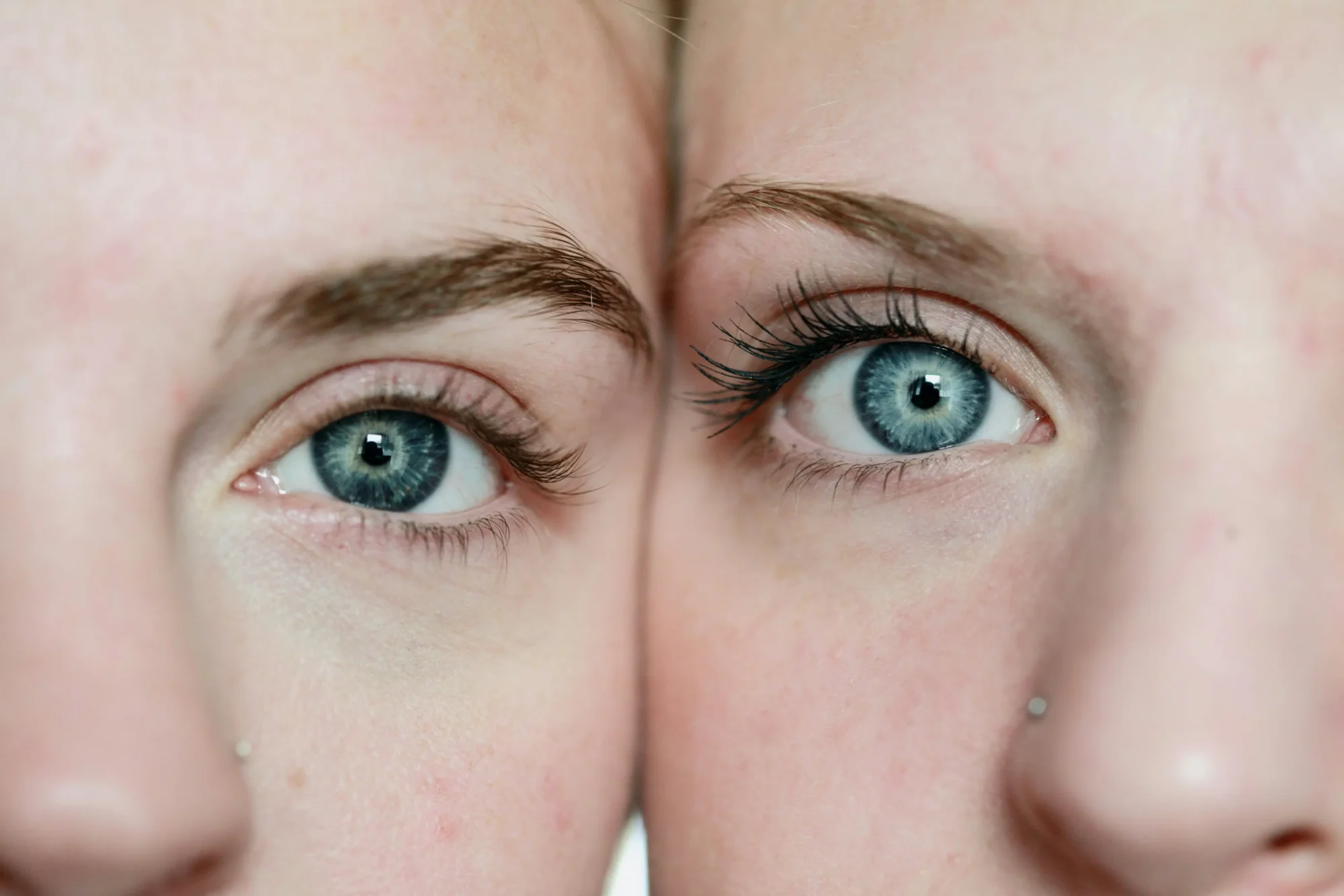 How Does SMILE Eye Surgery Differ From Traditional LASIK?