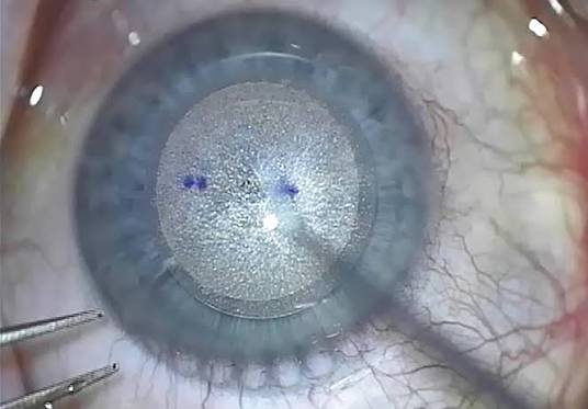 What Happens During A SMILE Laser Eye Surgery Procedure